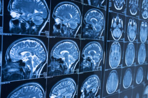 How Our Freehold Personal Injury Attorneys Can Help You With a Brain Injury Claim